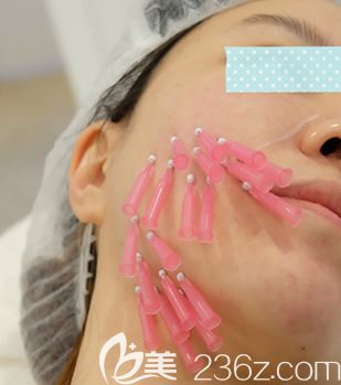 我在柳州仁美做面部埋線提升手術(shù)中 我在柳州仁美做面部埋線提升手術(shù)中