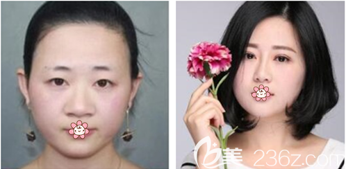 劉永濤雙眼皮+隆鼻案例 劉永濤雙眼皮+隆鼻案例