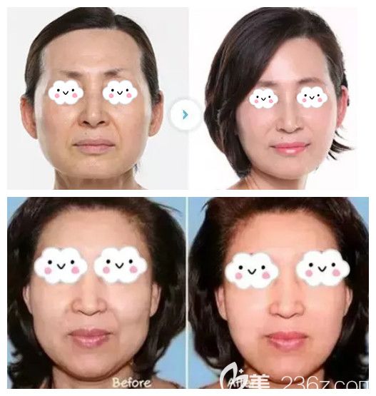 王晉茹做激光除皺案例 王晉茹做激光除皺案例