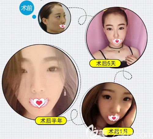 石家莊天宏整形醫(yī)院注射瘦臉除皺瘦臉案例