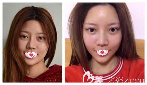 天宏整形做射頻除皺案例