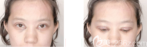 韓國愛慕雙眼皮+開內(nèi)眼角術(shù)后第1天效果