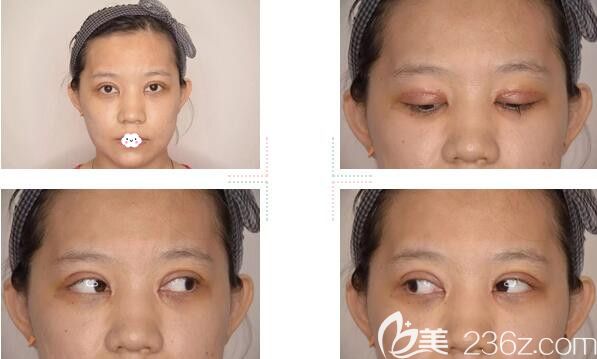 韓國愛慕全切雙眼皮+開內(nèi)眼角效果怎么樣？真人案例供參考