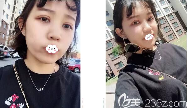 在韓國愛慕整形做全切雙眼皮+開內(nèi)眼角剛15天,現(xiàn)將術(shù)后恢復(fù)過程圖公開