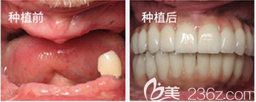 斯查爾曼全口種植牙案例 斯查爾曼全口種植牙案例