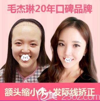 韓國植發(fā)毛杰琳黃晶煜院長真人案例效果對比圖