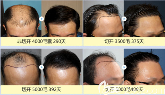 植發(fā)需要割頭皮嗎？韓國毛杰琳切開與非切開頭發(fā)種植案例效果圖