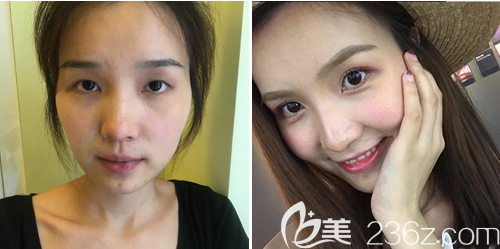 成都藝星整形美容醫(yī)院蔡靈雙眼皮術(shù)后效果 成都藝星整形美容醫(yī)院蔡靈雙眼皮術(shù)后效果