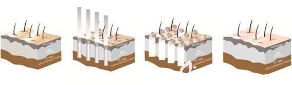 上海伯思立醫(yī)療美容門診部張程光子嫩膚原理 上海伯思立醫(yī)療美容門診部張程光子嫩膚原理