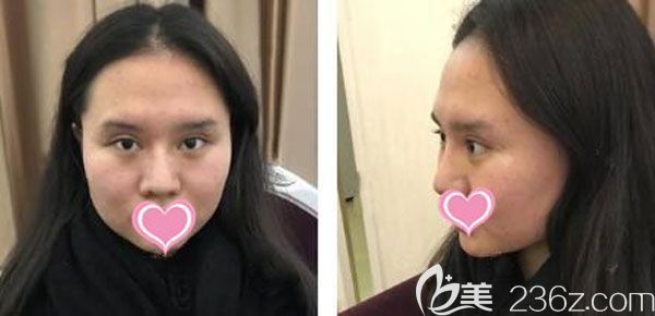 在昆明韓辰整形做面部吸脂手術(shù)前 在昆明韓辰整形做面部吸脂手術(shù)前