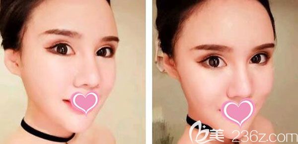 面部吸脂做完10天面部的腫脹和淤青已經(jīng)消退 面部吸脂做完10天面部的腫脹和淤青已經(jīng)消退