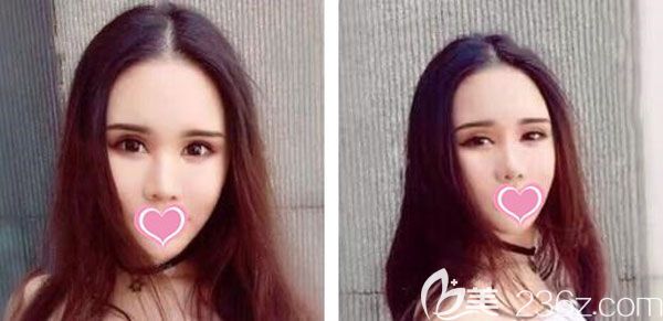 面部吸脂第二十天已經(jīng)定型 面部吸脂第二十天已經(jīng)定型