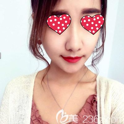 西寧康華<!--<i data=20240703-sp></i>-->院長(zhǎng)給我注射玻尿酸豐下巴術(shù)后第7天效果 西寧康華<!--<i data=20240703-sp></i>-->院長(zhǎng)給我注射玻尿酸豐下巴術(shù)后第7天效果