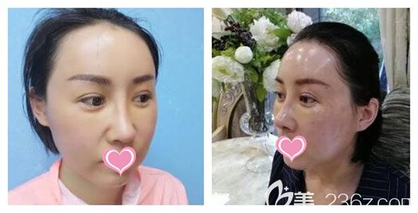 全臉脂肪填充第3—5天恢復圖