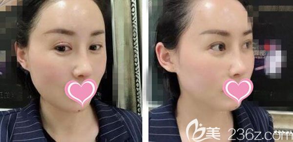 脂肪填充15天淤青也已經不明顯