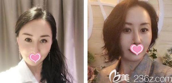 面部脂肪填充第20天皮膚光滑圓潤