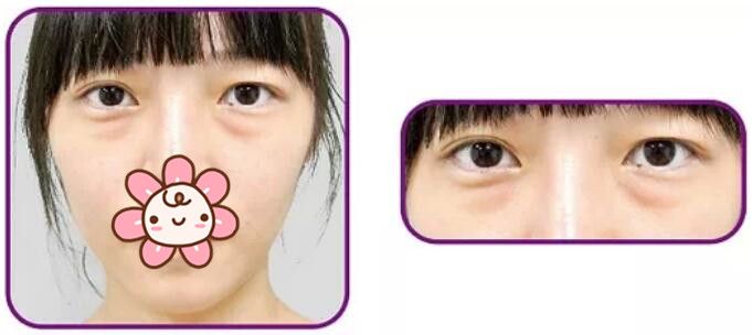 常熟時(shí)代醫(yī)生區(qū)分脂肪型和浮腫型眼袋