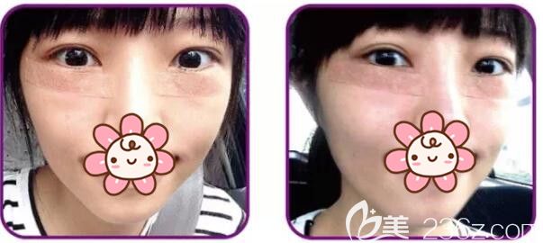 做完定制無(wú)痕祛眼袋術(shù)后第二天