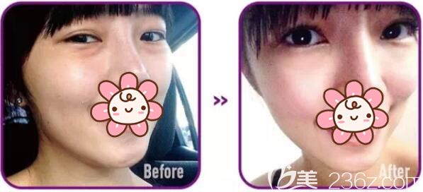 去眼袋術(shù)后兩周與術(shù)前相比效果明顯