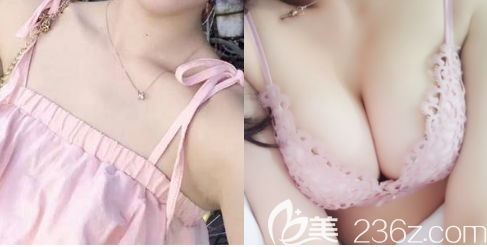 賀忠波隆胸怎么樣