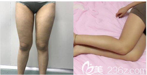 賀忠波吸脂怎么樣