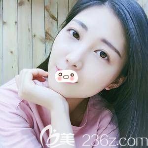 洛陽華美自體脂肪填充術(shù)后7i天