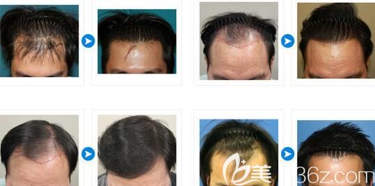 韓國JP毛發(fā)移植崔鐘弼植發(fā)案例 韓國JP毛發(fā)移植崔鐘弼植發(fā)案例