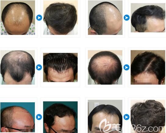 韓國JP毛發(fā)移植植發(fā)案例