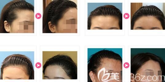 韓國JP女性發(fā)際線種植案例 韓國JP女性發(fā)際線種植案例