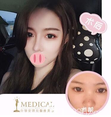 <!--<i data=20240703-sp></i>-->鼻綜合案例效果對(duì)比圖