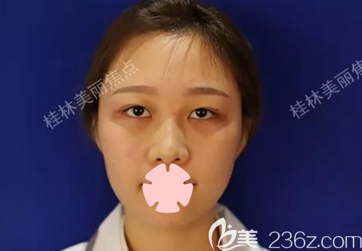 我在桂林美麗焦點做鼻綜合隆鼻術(shù)前照 我在桂林美麗焦點做鼻綜合隆鼻術(shù)前照