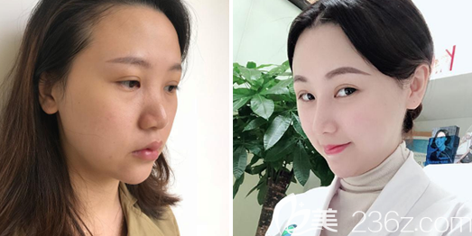 佛山曙光金子宋仁剛做的肋軟骨隆鼻案例