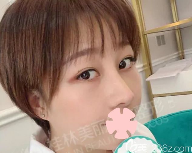 我在桂林美麗焦點做鼻綜合術(shù)后第7天 我在桂林美麗焦點做鼻綜合術(shù)后第7天