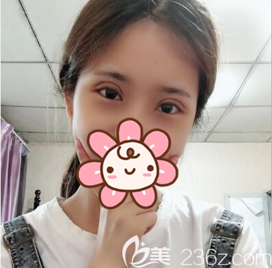 成都恒博李烈切開(kāi)雙眼皮拆線后效果