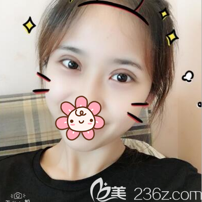 切開(kāi)雙眼皮術(shù)后一個(gè)月恢復(fù)效果