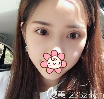 李烈帕克法雙眼皮術(shù)后2個(gè)月恢復(fù)照