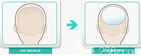 韓國(guó)ITEM愛(ài)婷填充后腦勺手術(shù)