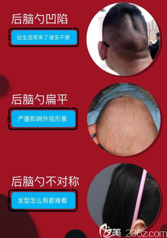 哪些人適合做后腦勺填充？后腦勺凹陷、扁平、不對(duì)稱(chēng)者