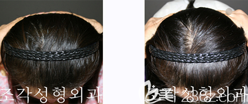 韓國(guó)雕刻宋龍?zhí)┖竽X勺填充案例前后效果對(duì)比圖