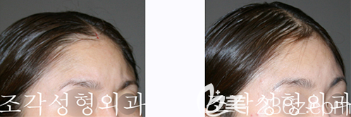 韓國(guó)雕刻宋龍?zhí)┕撬嗵畛漕^案例