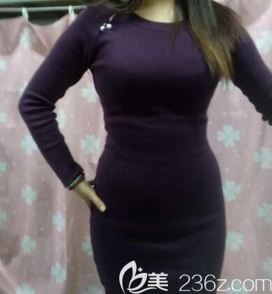 我在美麗焦點整形做腰腹部吸脂減肥術(shù)后第10天 我在美麗焦點整形做腰腹部吸脂減肥術(shù)后第10天