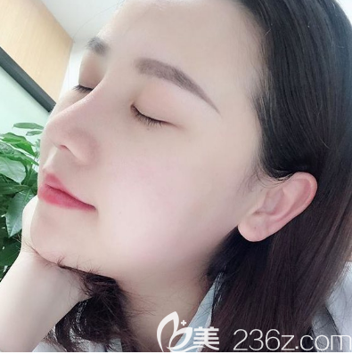 佛山曙光金子宋仁剛博士做的隆鼻子案例 佛山曙光金子宋仁剛博士做的隆鼻子案例