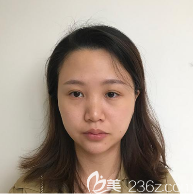 在佛山曙光金子隆鼻術前照片 在佛山曙光金子隆鼻術前照片