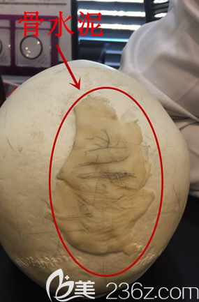 骨水泥填充后腦勺模擬圖片