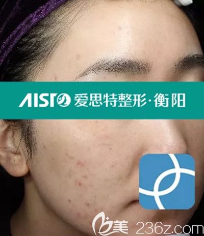 治療前的照片 治療前的照片