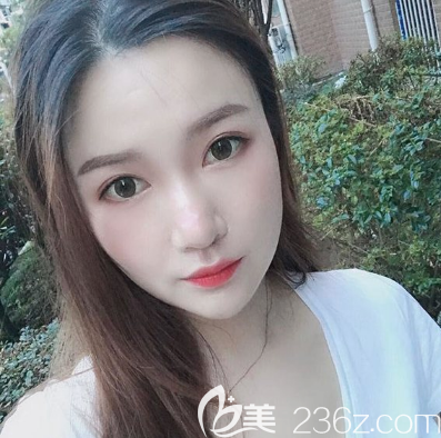 全切雙眼皮術(shù)后7天拆線效果圖 全切雙眼皮術(shù)后7天拆線效果圖