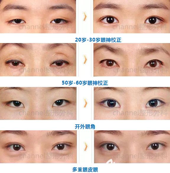 韓國CHANNEL綜合整形外科醫(yī)院雙眼皮案例 韓國CHANNEL綜合整形外科醫(yī)院雙眼皮案例