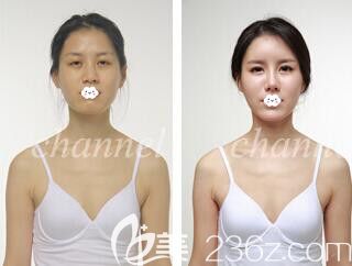 韓國CHANNEL雙眼皮修復(fù)+假體隆胸+自體脂肪面部填充案例 韓國CHANNEL雙眼皮修復(fù)+假體隆胸+自體脂肪面部填充案例