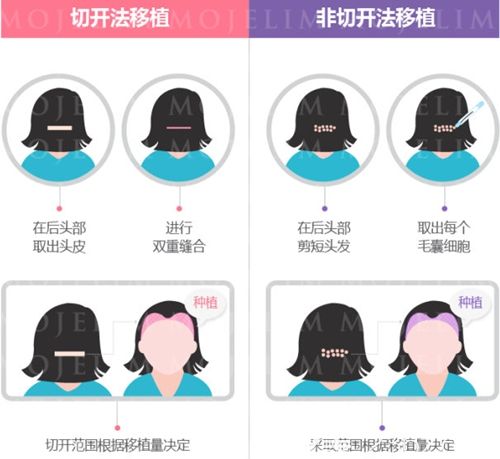 毛杰琳植切開和非切開毛發(fā)移植