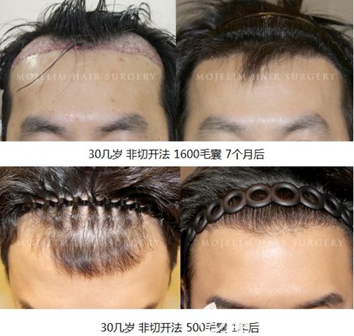 韓國毛杰琳男士植發(fā)實例